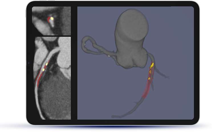 Autoplaque software visualization